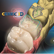 Cerec