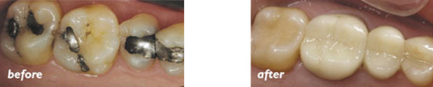 Tooth-colored fillings