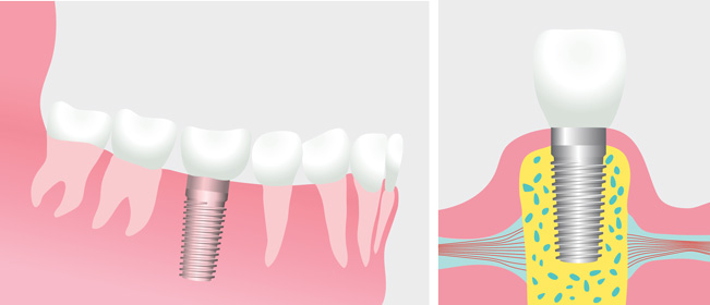 Dental Implant