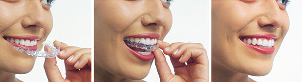 Invisalign