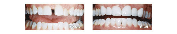 veneers